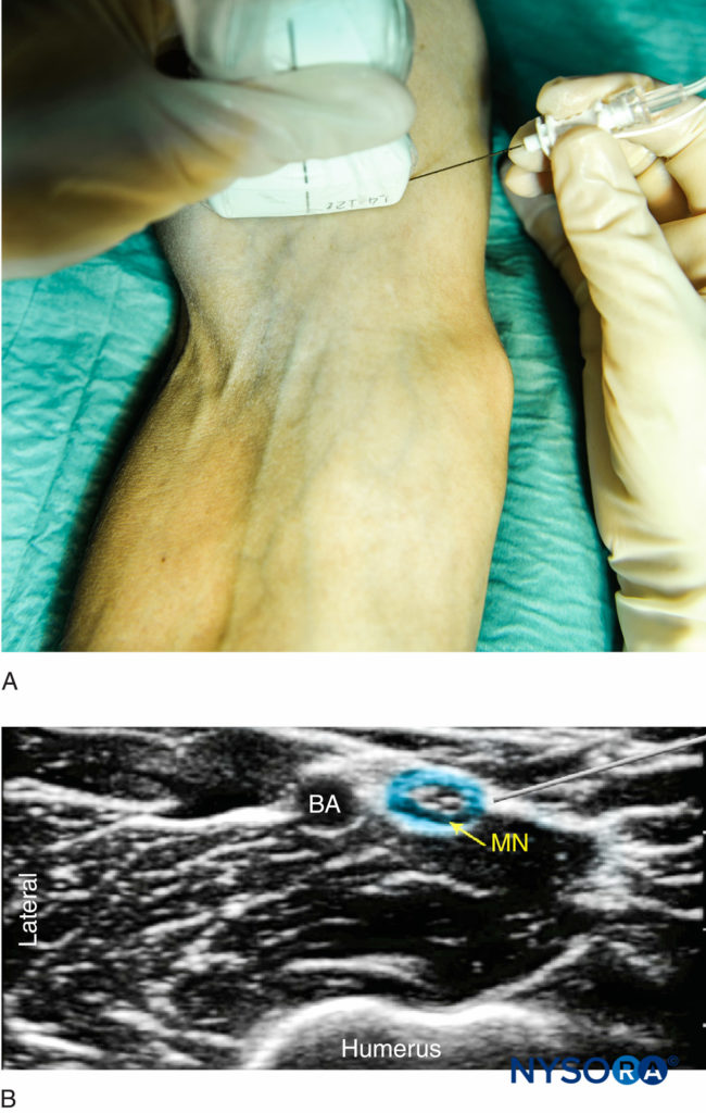 Ultrasound Guided Blocks At The Elbow Nysora