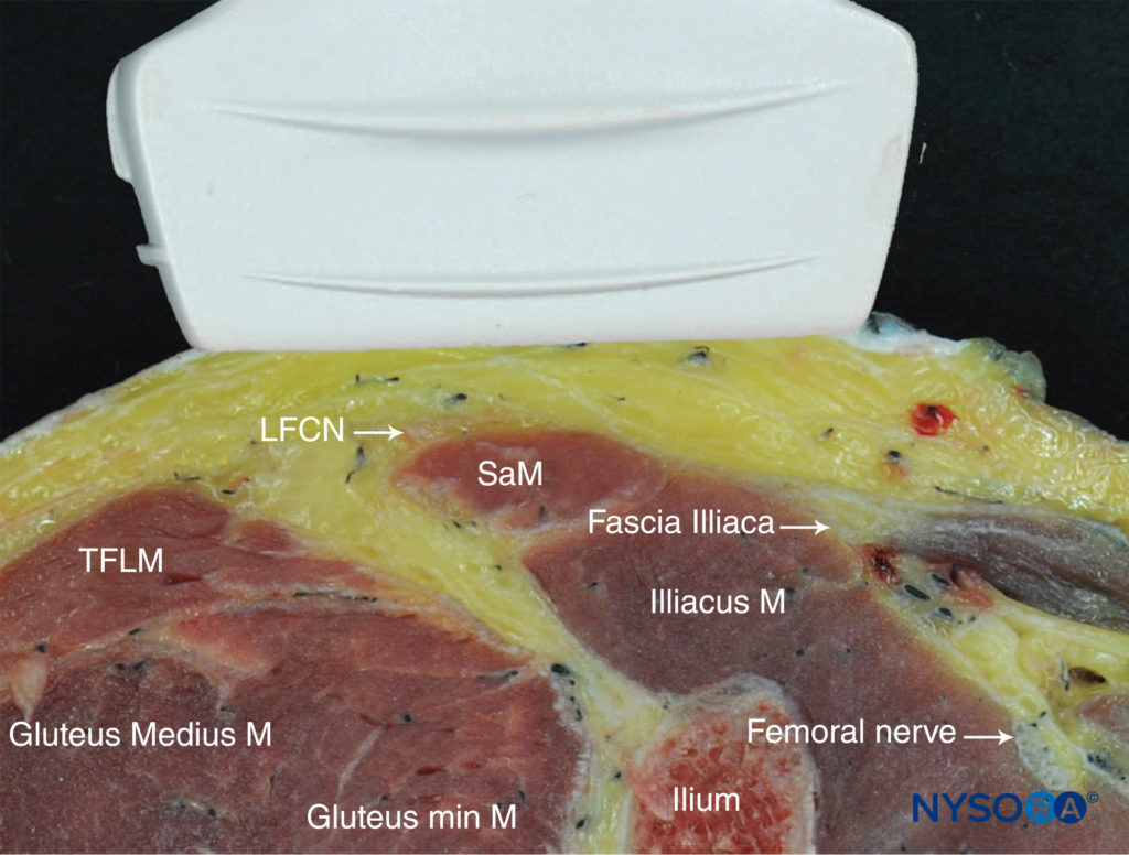 Ultrasound-Guided Lateral Femoral Cutaneous Nerve Block - NYSORA