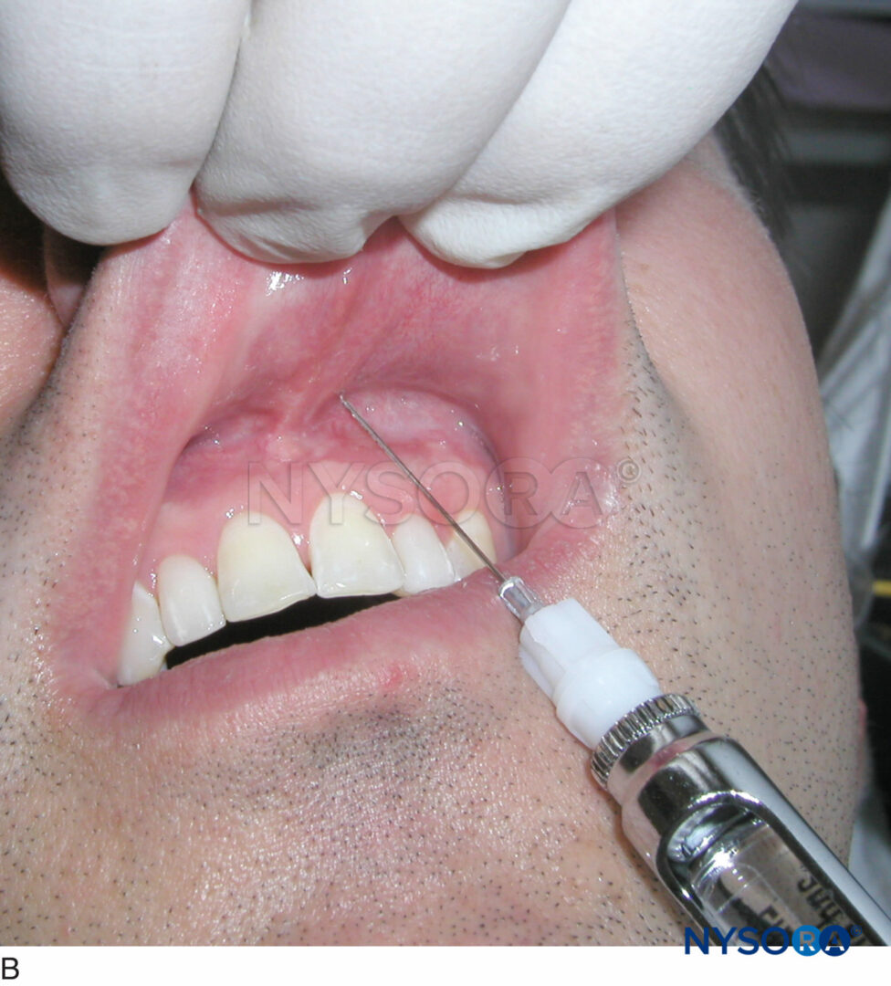 Oral Maxillofacial Regional Anesthesia Nysora