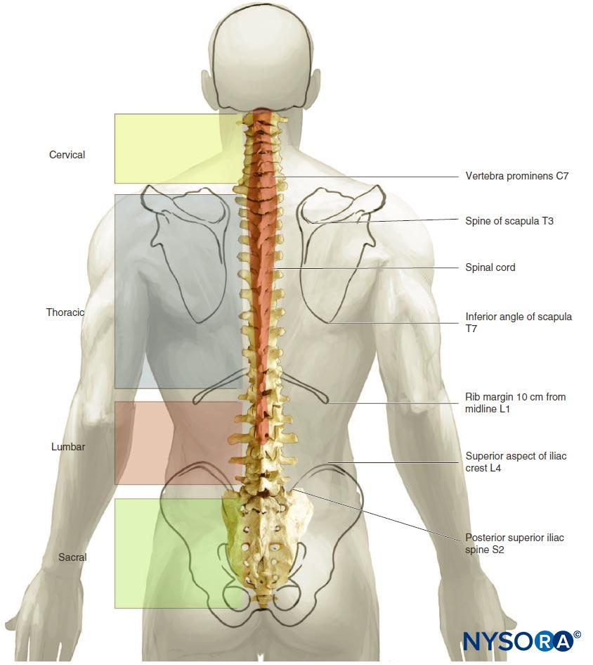 Epidural Anesthesia and Analgesia - NYSORA