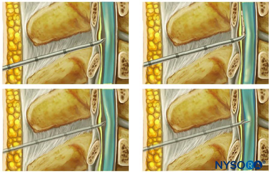 Combined Spinal-Epidural Anesthesia - NYSORA