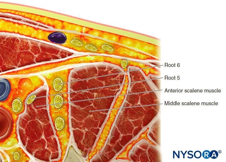 Ultrasound-Guided Interscalene Brachial Plexus Block - NYSORA