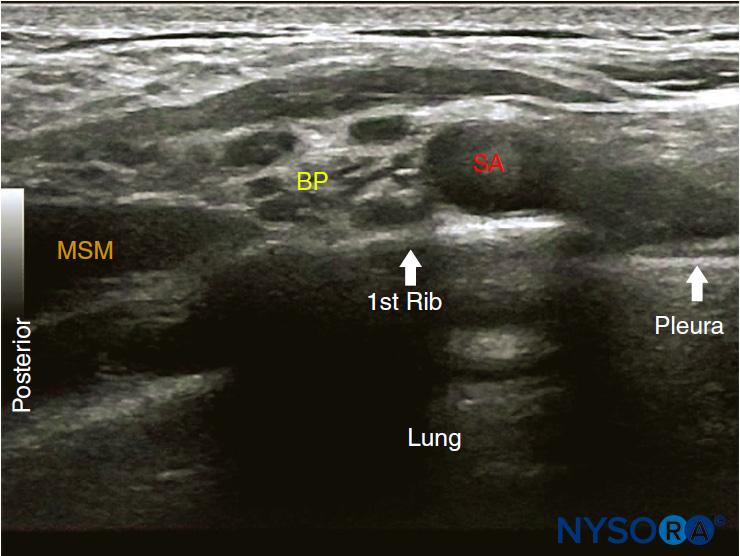 Ultrasound-Guided Interscalene Brachial Plexus Block - NYSORA