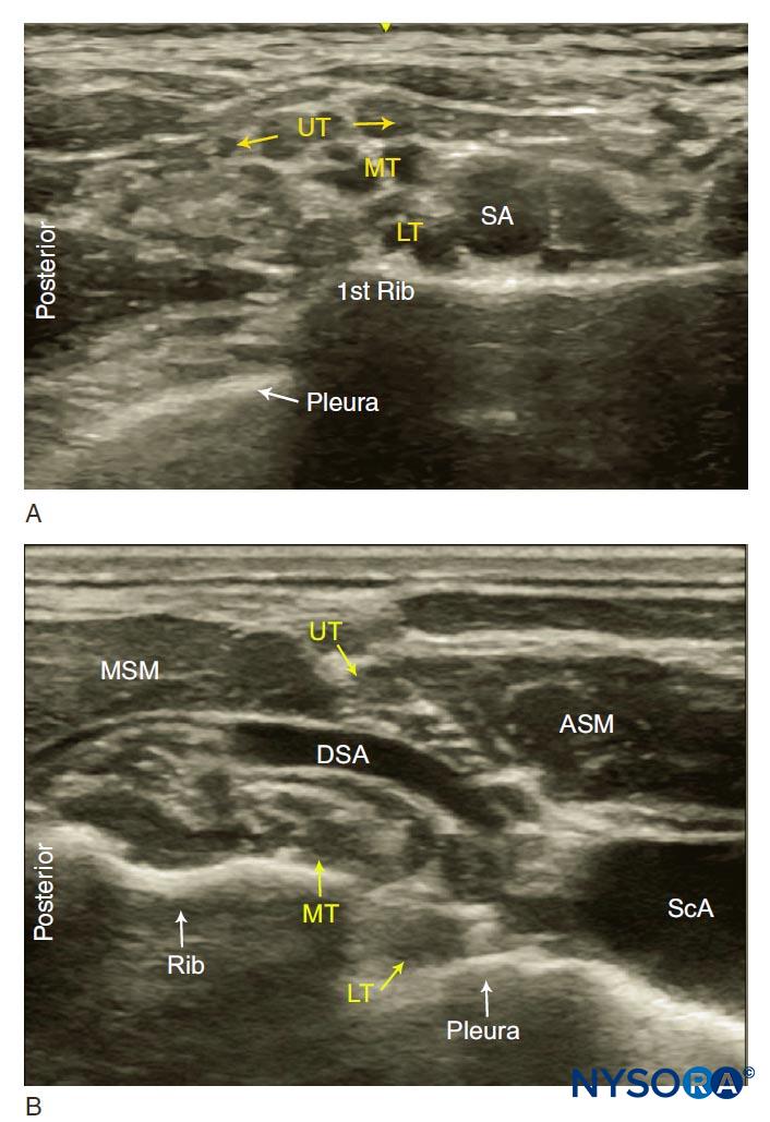 Supraclavicular Brachial Plexus Block