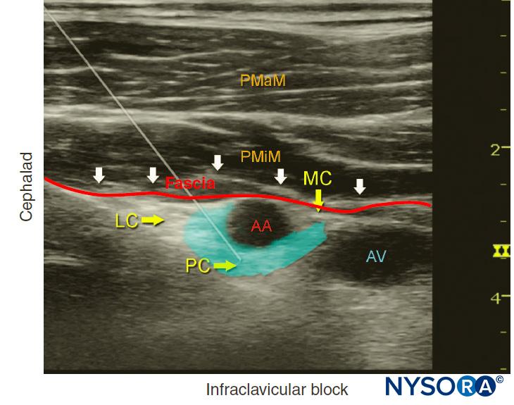 Brachial Plexus Block Ultrasound