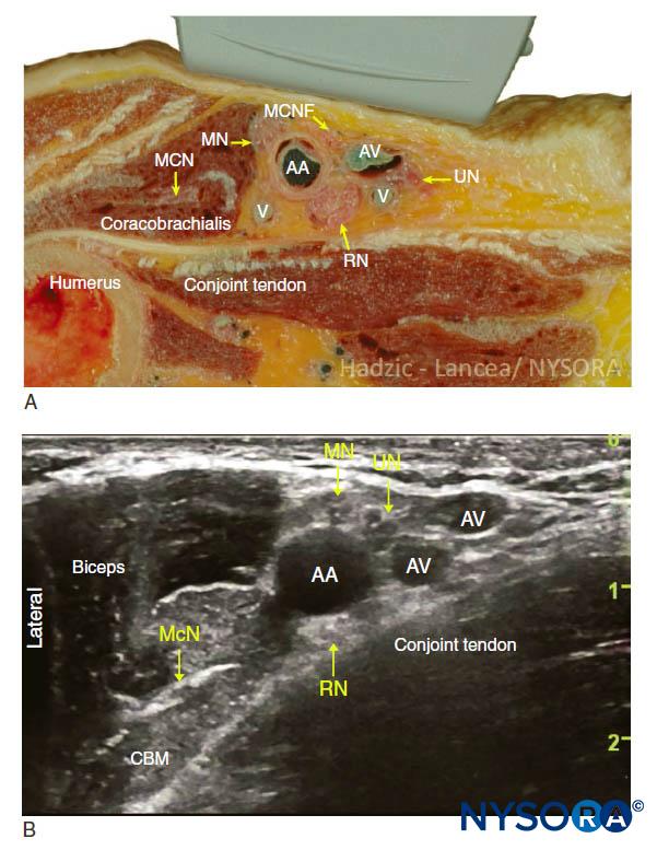 Ultrasound Guided Axillary Brachial Plexus Block Nysora 6740