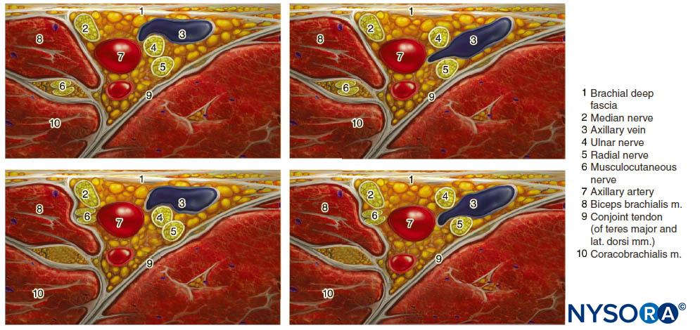 Ultrasound Guided Axillary Brachial Plexus Block Nysora