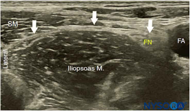 Ultrasound-Guided Fascia Iliaca Block - NYSORA