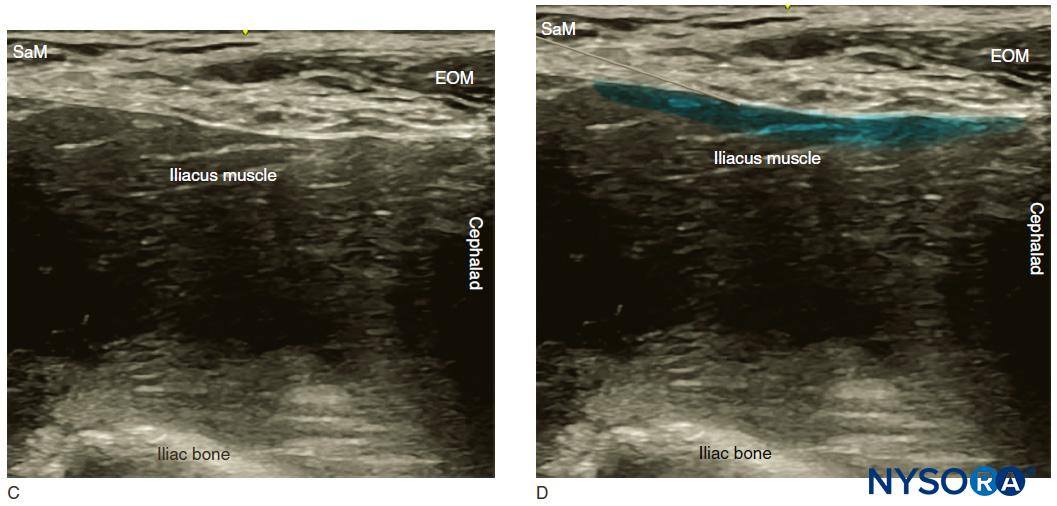 Ultrasound-Guided Fascia Iliaca Block - NYSORA