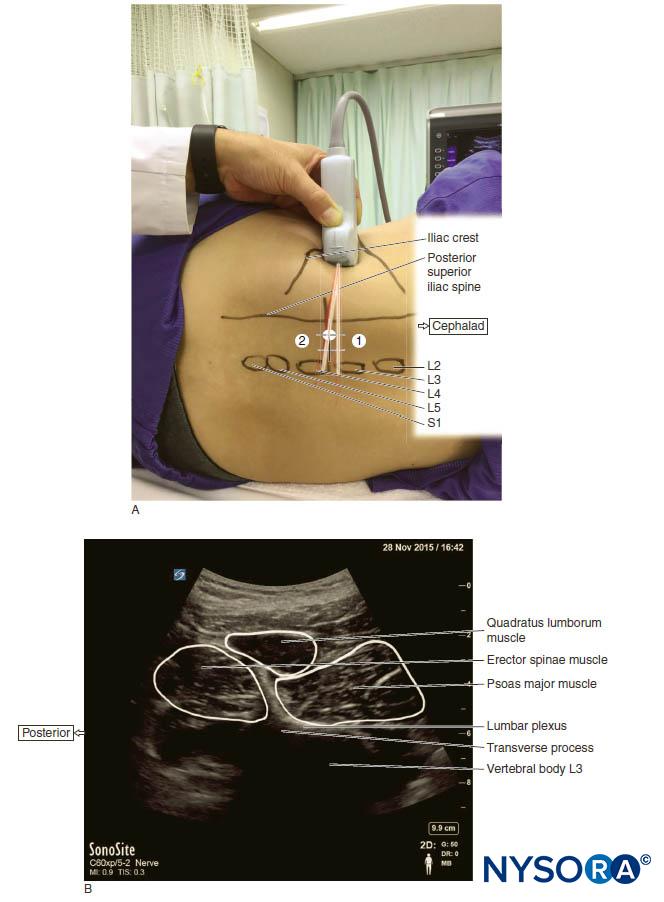 Sonography of the Lumbar Paravertebral Space and Considerations for the ...