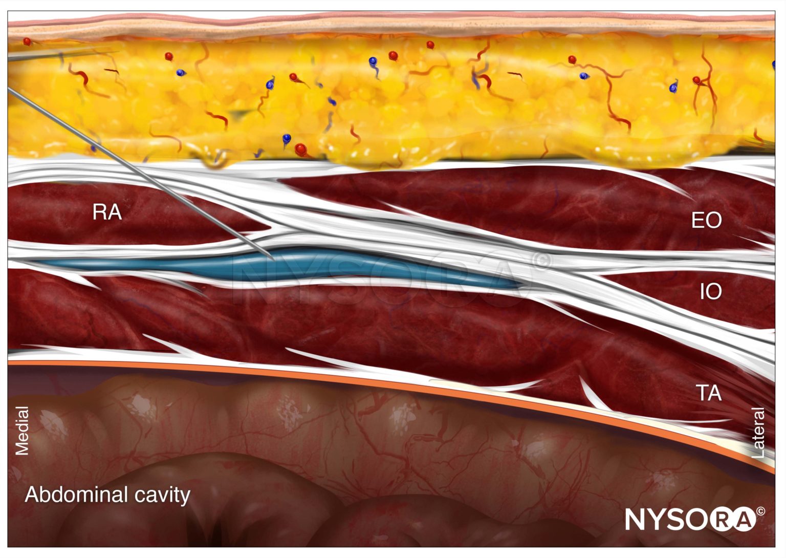 Figure 5.6.5. Trunk_TAP_Subcostal_Needle_RUA Copy - NYSORA