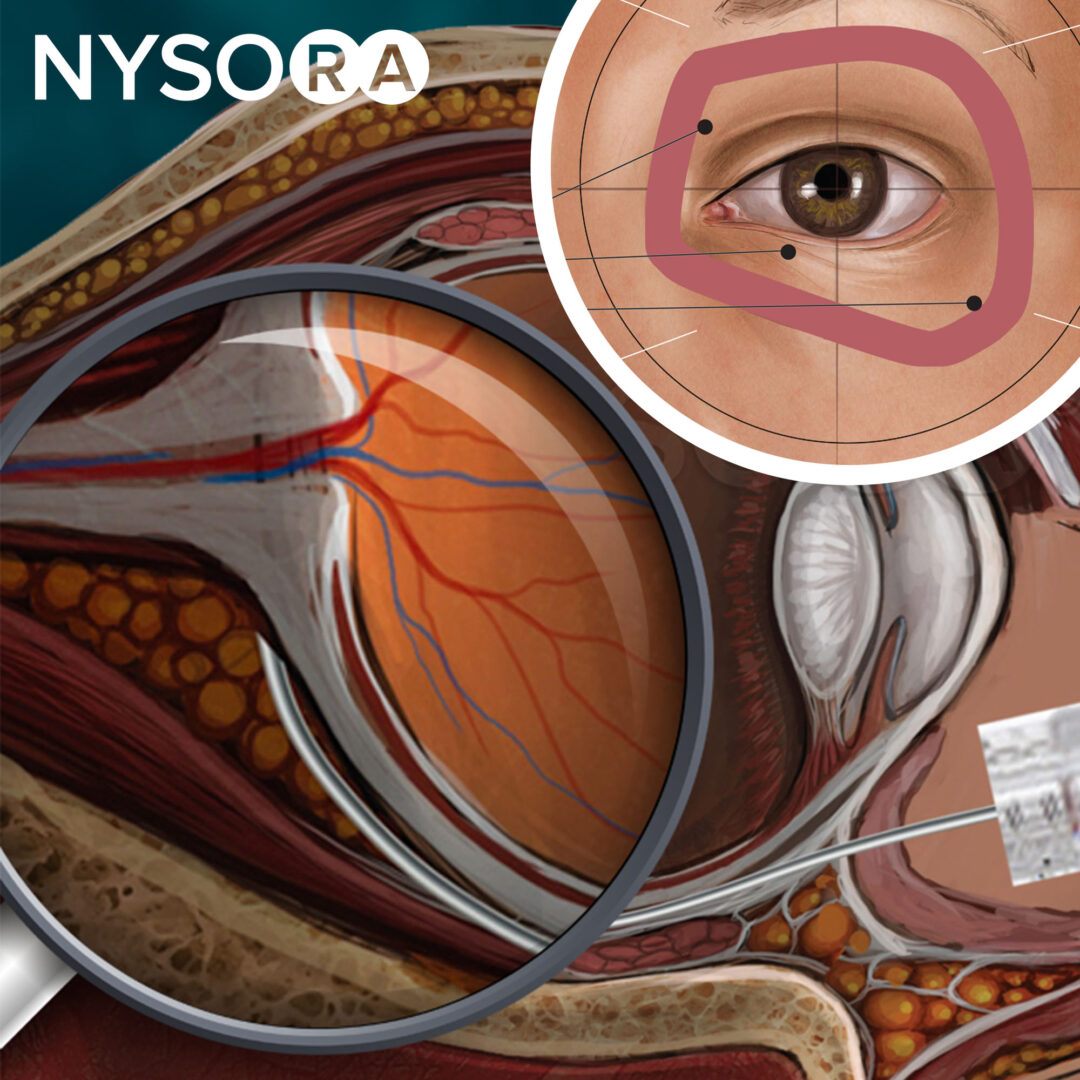 眼科手术的局部和区域麻醉- NYSORA