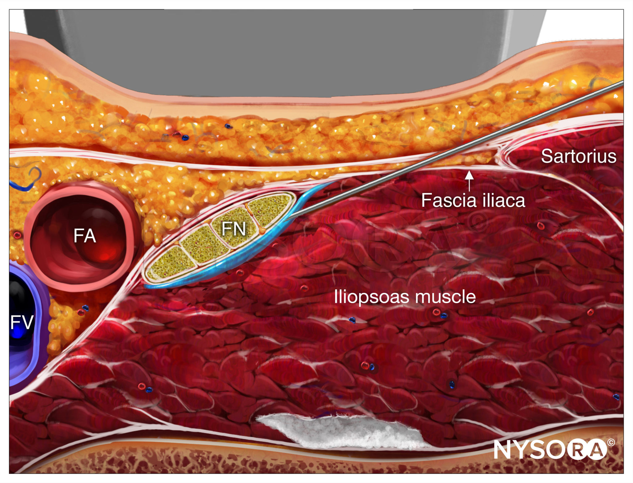 Le Femoral Reverse Needle Copy Nysora - vrogue.co