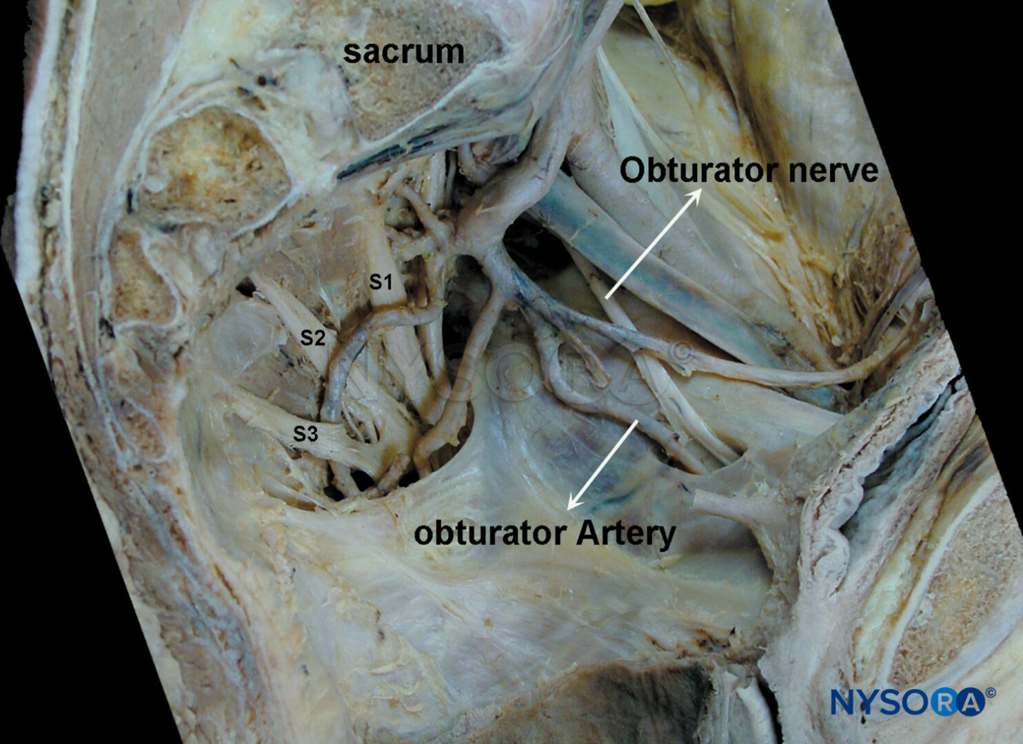Obturator Nerve Block - Landmarks and nerve stimulator technique - NYSORA