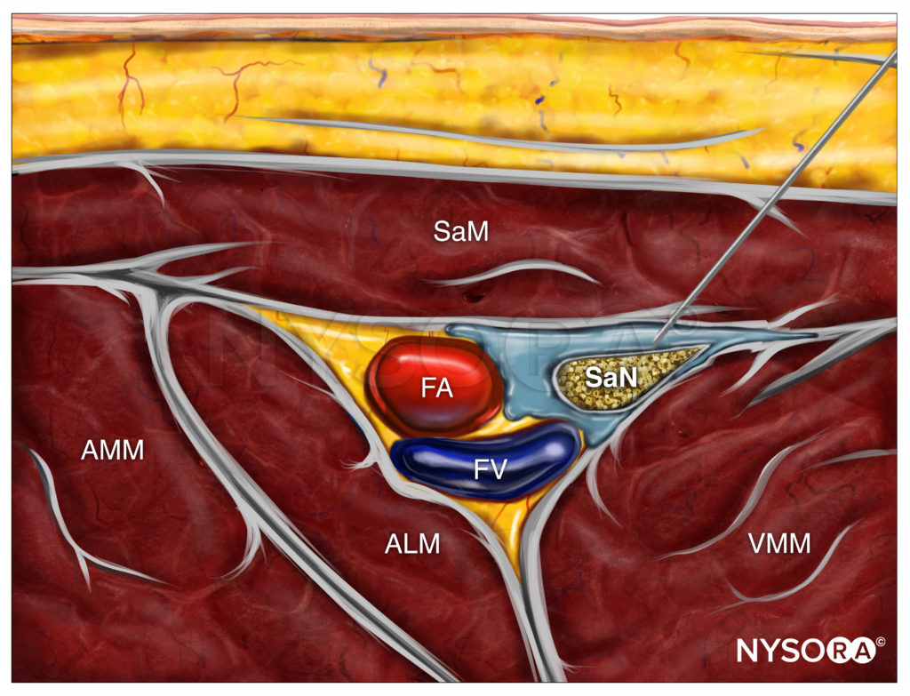 Ultrasound-Guided Saphenous (Adductor Canal) Block - NYSORA