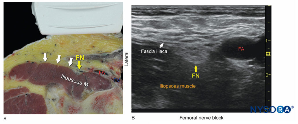 Regional Anestehsia Cross Sectional Anatomy Of The Femoral Nerve At The Level Of The Femoral 8431