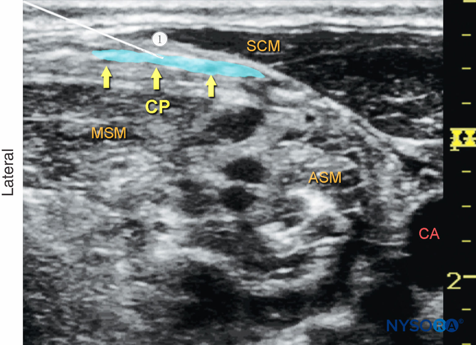 Regional Anesthesia Cervical Plexus Transverse View 1 Nysora 2072