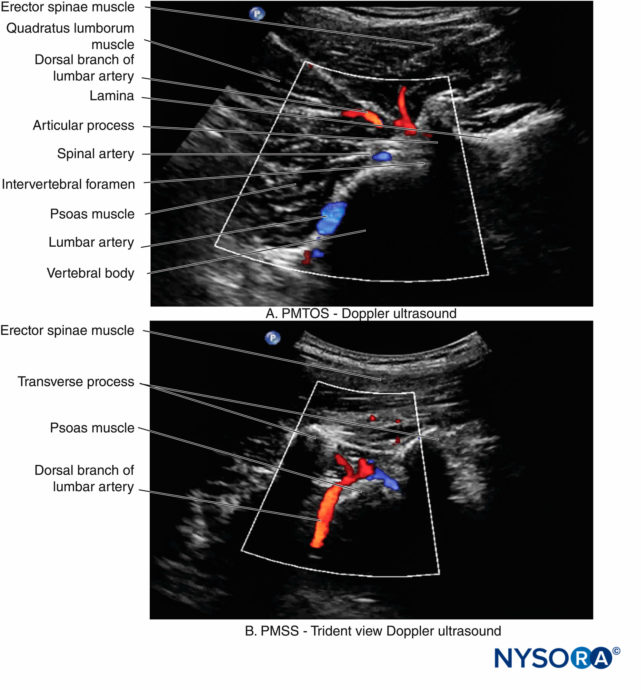 Lumbar Paravertebral Sonography and Considerations for Ultrasound ...