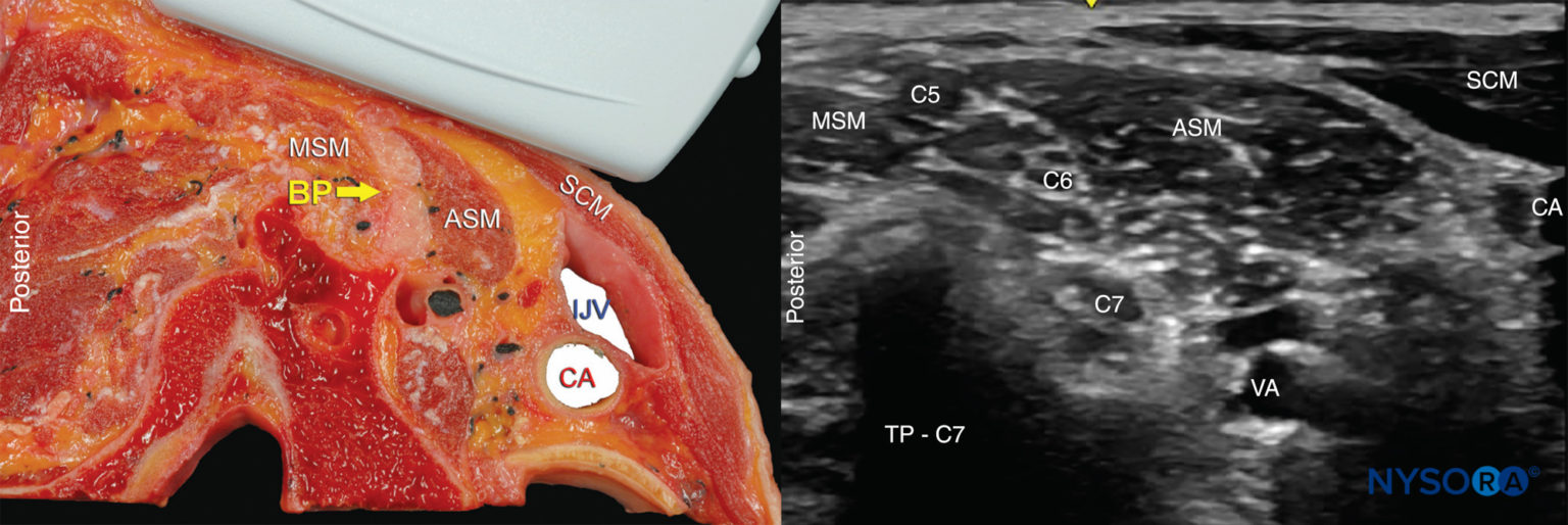 Ultrasound-Guided Interscalene Brachial Plexus Nerve Block - NYSORA