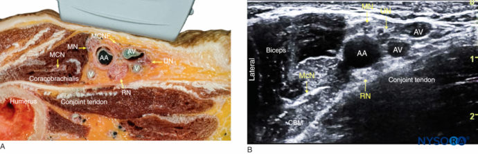 Ultrasound-Guided Axillary Brachial Plexus Block - NYSORA