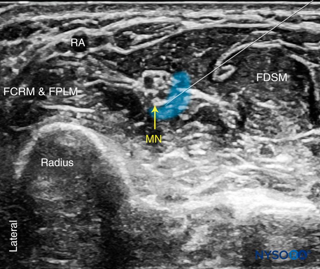 Regional Anesthesia Cross Sectional Ultrasound Image Of The Median Nerve At The Wrist Nysora