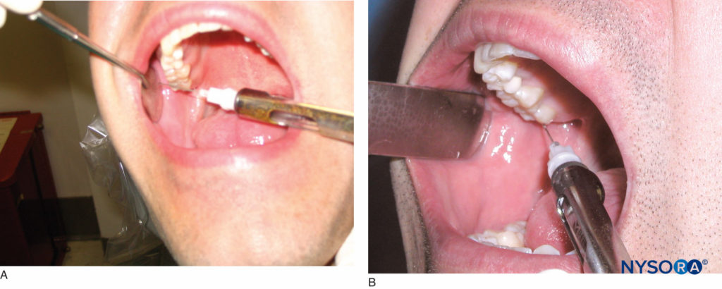 Anestesia Regional Oral e Maxilofacial - NYSORA