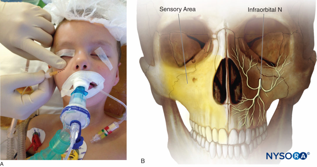 Nerve Blocks of the Face - NYSORA