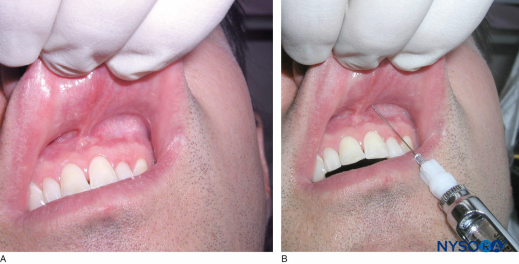 Oral & Maxillofacial Regional Anesthesia - NYSORA