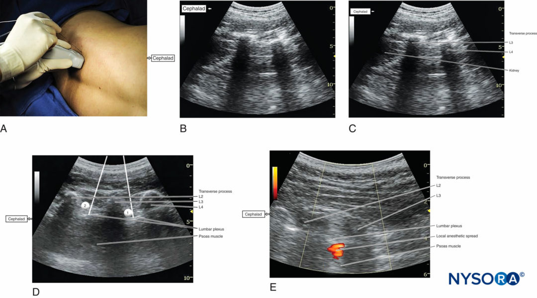 Sonography Of The Lumbar Paravertebral Space And Considerations For The