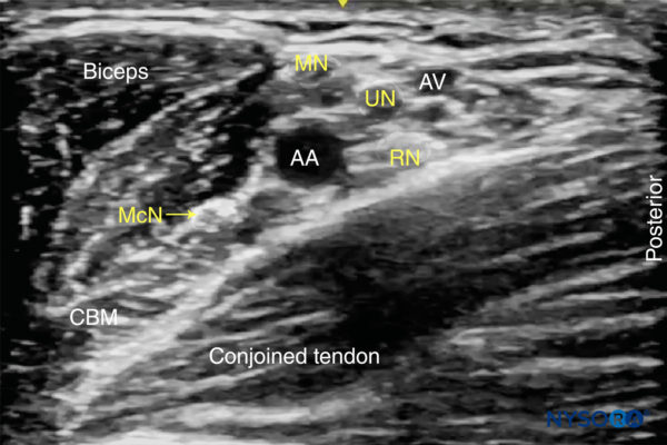 Ultrasound-Guided Axillary Brachial Plexus Block - NYSORA