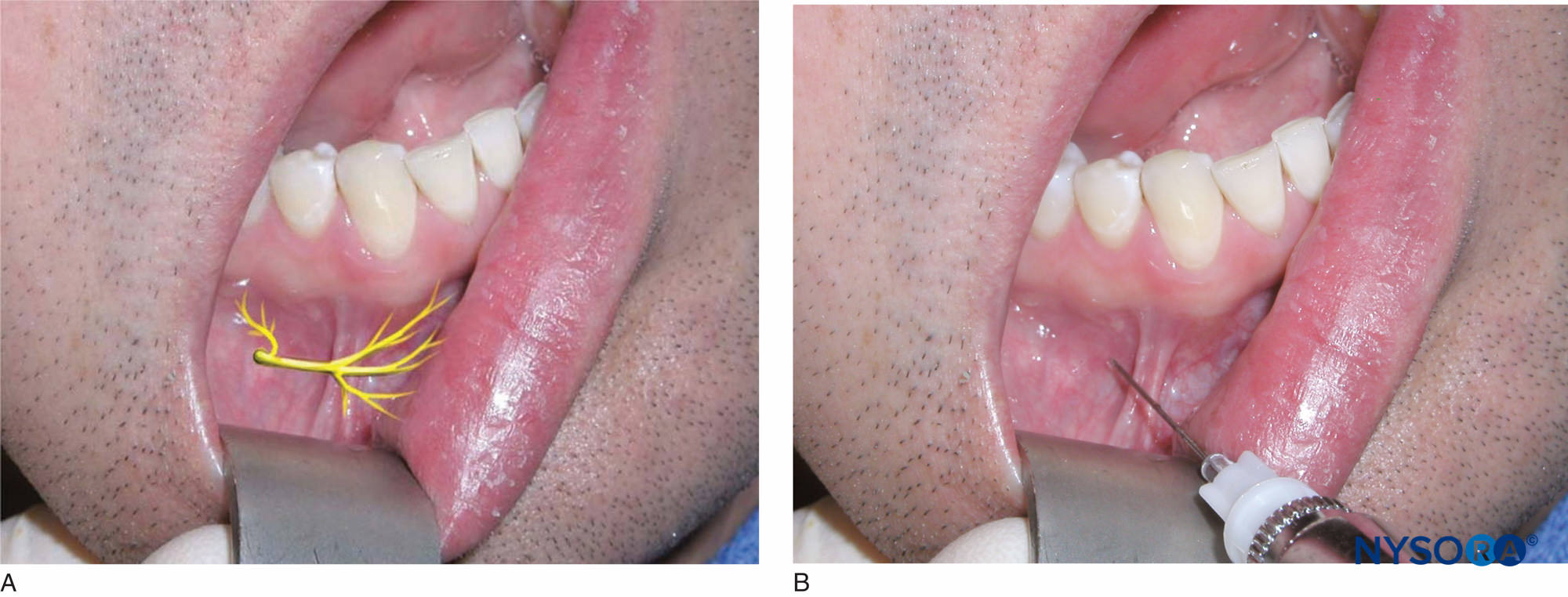 Regional anesthesia mental and incisive nerves location block of the 