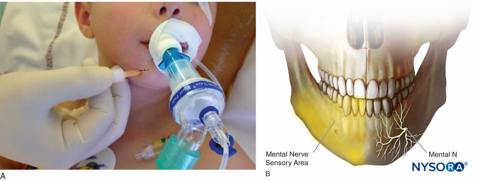 anestesia-regional-bloqueo-del-nervio-mental-zona-sensorial-del-nervio ...