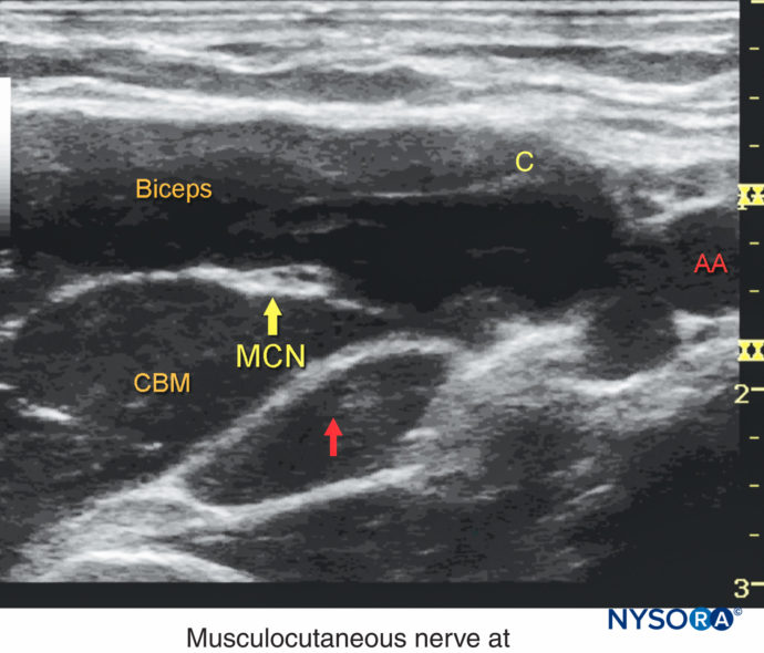 Ultrasound-Guided Axillary Brachial Plexus Block - NYSORA