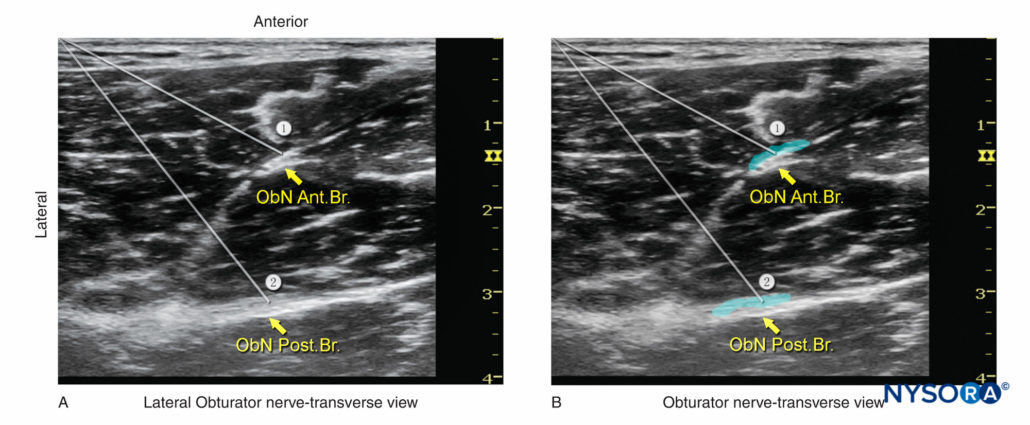 Bloc Nerveux Obturateur Guidé Par Ultrasons Nysora 2181