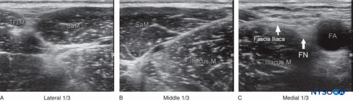 Ultrasound-Guided Fascia Iliaca Nerve Block - NYSORA | NYSORA