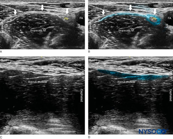 Ultrasound-Guided Fascia Iliaca Nerve Block - NYSORA | NYSORA