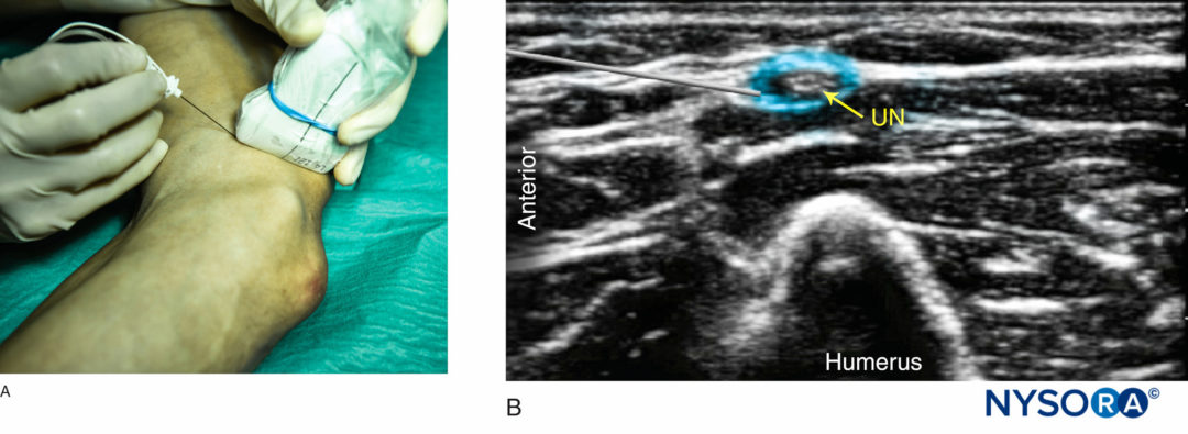 Ultrasound-Guided Blocks at the Elbow - NYSORA