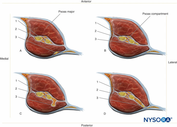 Regional Anesthesia Position Of The Lateral Femoral Cutaneous Femoral