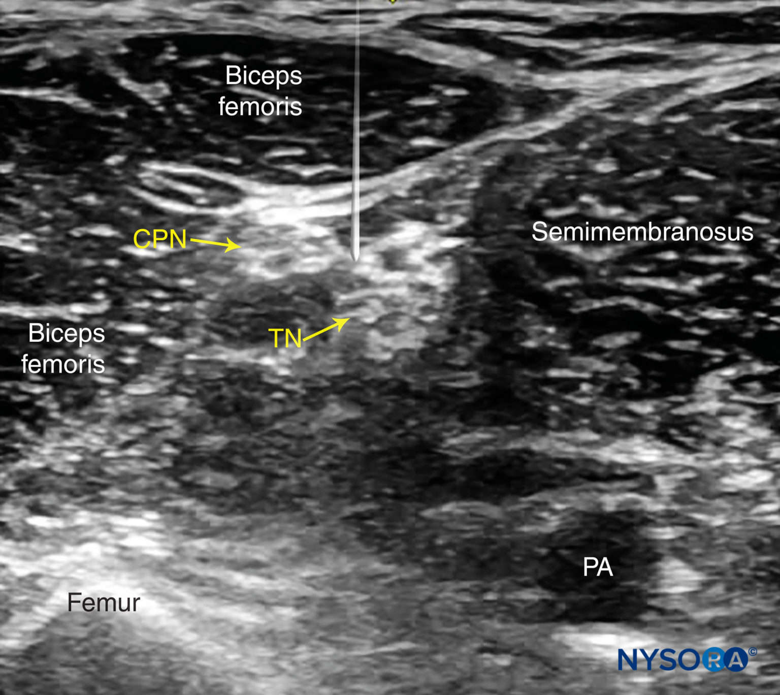 Ultrasound-Guided Popliteal Sciatic Nerve Block - NYSORA