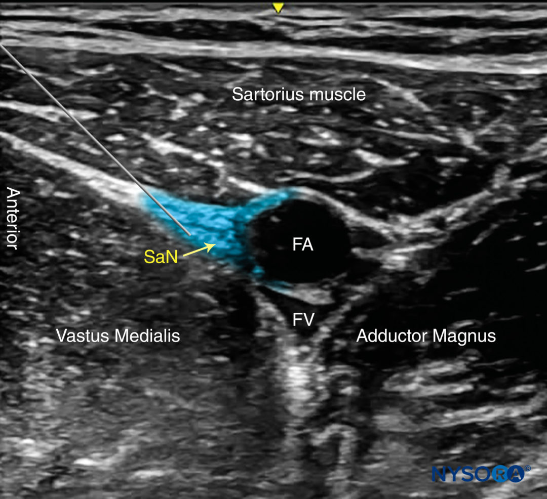 Ultrasound-Guided Saphenous (Adductor Canal) Nerve Block - NYSORA | NYSORA