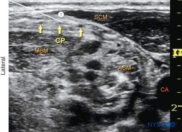 Ultrasound Guided Cervical Plexus Nerve Block Nysora