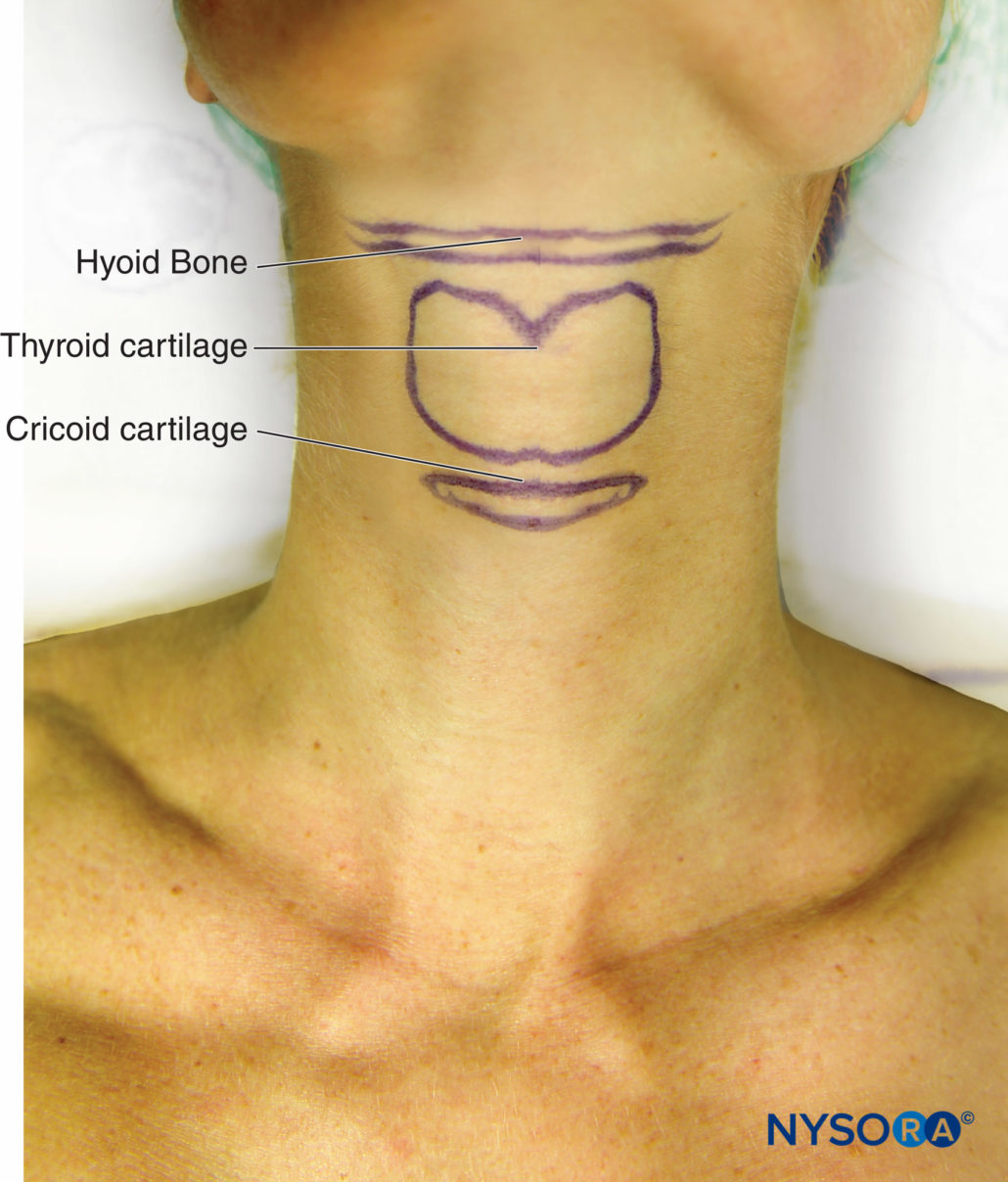 Regional-anesthesia-surface-anatomy-of-hyoid-bone-thyroid-and-cricoid ...