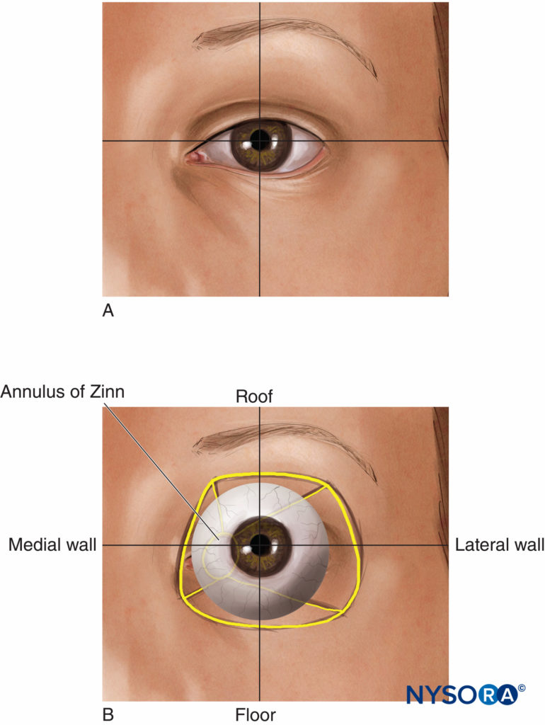 眼科手术的局部和区域麻醉- NYSORA