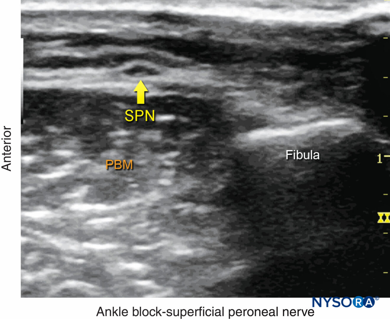 superficial peroneal nerve block