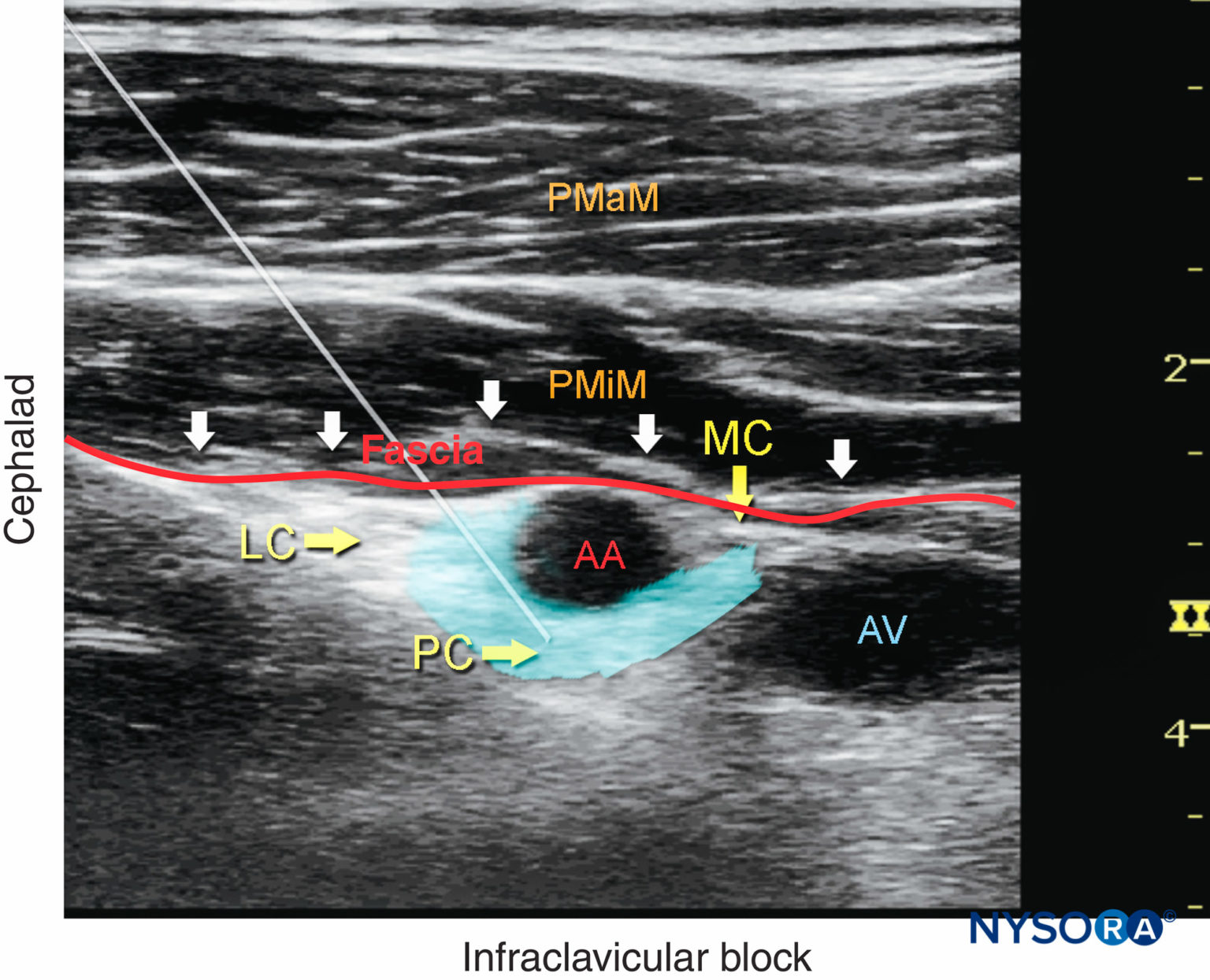 Bloqueo Del Nervio Del Plexo Braquial Infraclavicular Guiado Por Ultrasonido Nysora