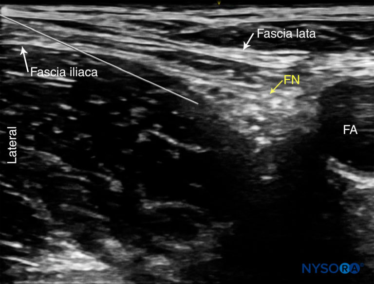 Ultrasound-Guided Femoral Nerve Block - NYSORA