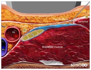 Ultrasound-Guided Fascia Iliaca Nerve Block - NYSORA | NYSORA