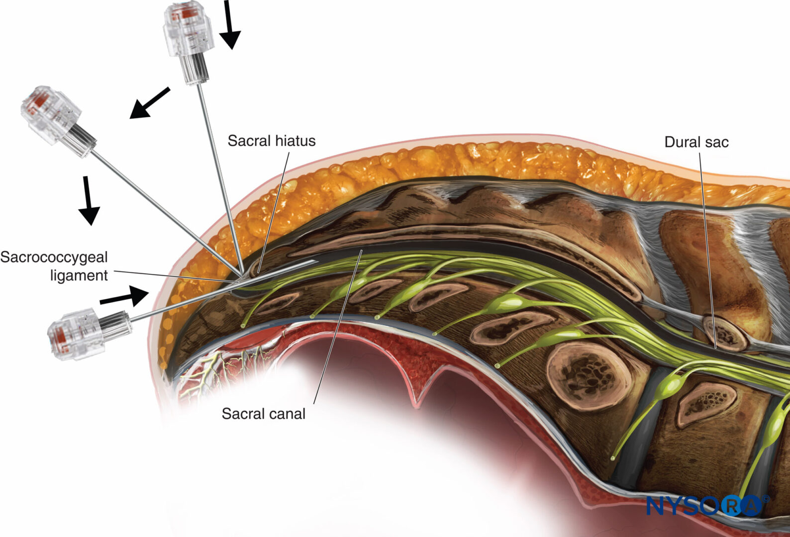 Caudal Epidural Anatomy