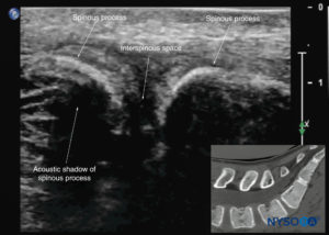 Spinal Sonography and Applications of Ultrasound for Central Neuraxial ...