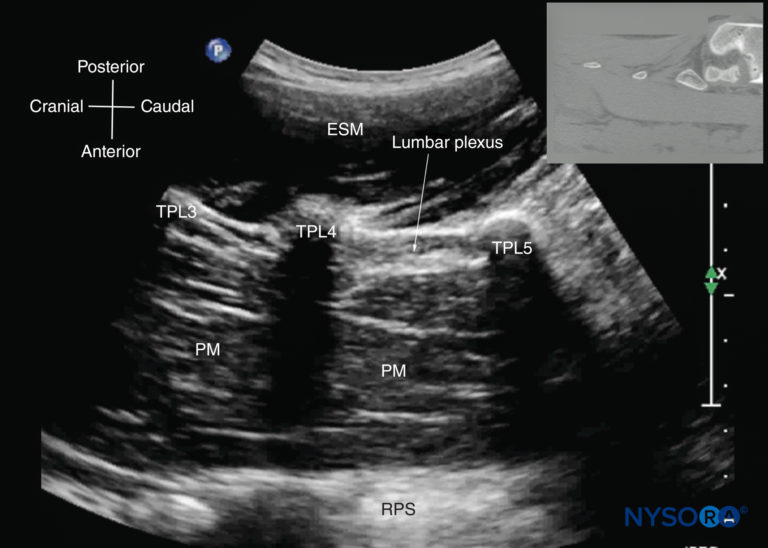 Spinal Sonography and Applications of Ultrasound for Central Neuraxial ...